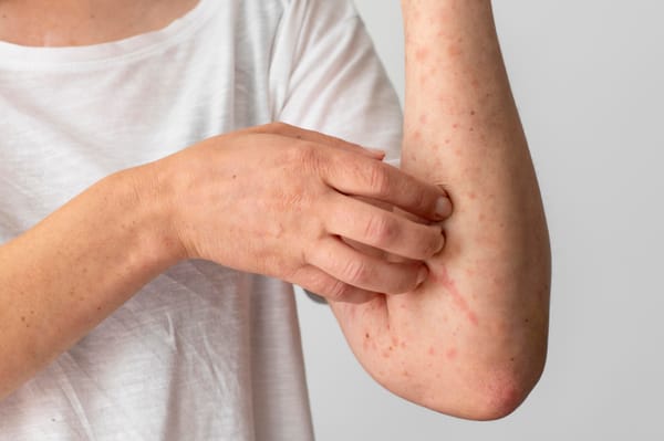 Alergia por estrés o alergia nerviosa: síntomas, tipos y cómo calmarla